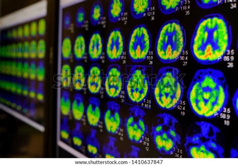 Pet Ct Scan Human Brain Axial Stock Photo 1410637847 | Shutterstock