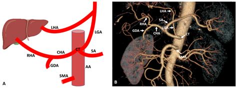 Hepatic Artery