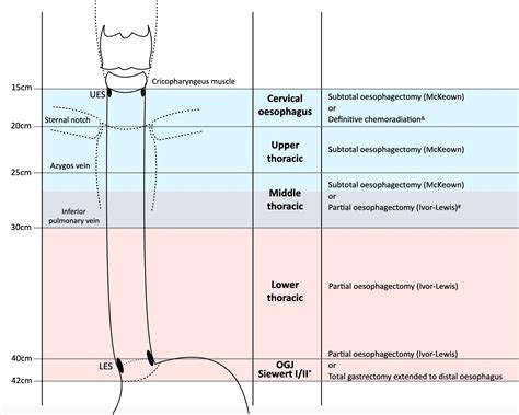 The management of oesophageal cancer: the surgeon’s perspective - BJS ...