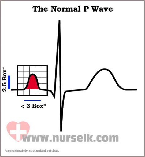 How to read an Electrocardiogram (ECG) - Part 3, The P Wave | Nurselk.com