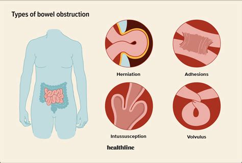 Female Bowel Obstruction Symptoms And Treatment Options | The Best Porn Website