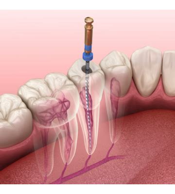 Root Canal Pain After Treatment (All You Need To Know)