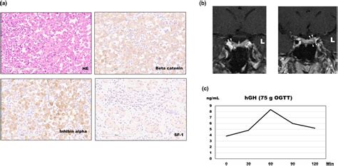 Clinical manifestations of Carney complex in a patient based on ...