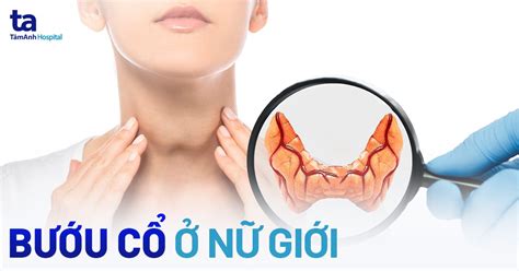 Bướu cổ ở nữ giới: Dấu hiệu, nguyên nhân và cách điều trị