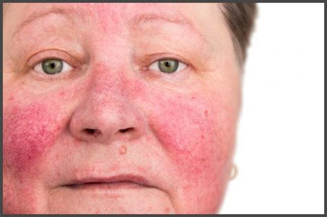 Psoriasis on face pictures | Psoriasis expert