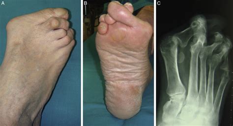 Fusion of the First Metatarsophalangeal Joint and Second to Fifth Metatarsal Head Resection for ...