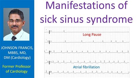 Manifestations of sick sinus syndrome - YouTube