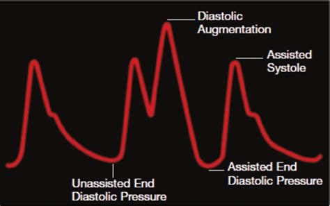 Arterial tracing with early deflation. Early deflation causes... | Download Scientific Diagram