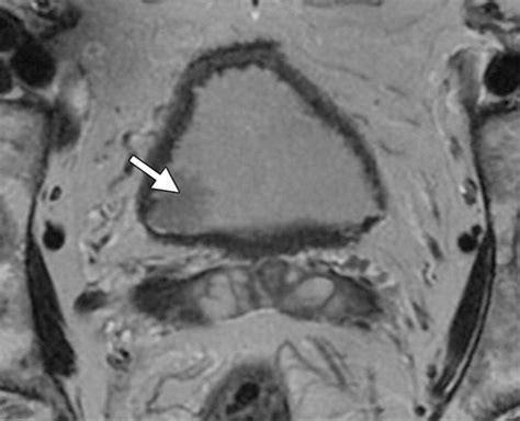 Urinary Bladder Cancer: Role of MR Imaging | RadioGraphics