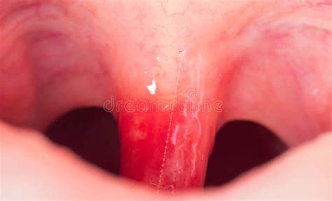 Inflammation of the Uvula in the Oral Cavity Due To Infection and Virus. Treatment of the ...