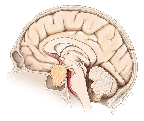 Pituitary Macroadenoma | The Neurosurgical Atlas, by Aaron Cohen-Gadol ...