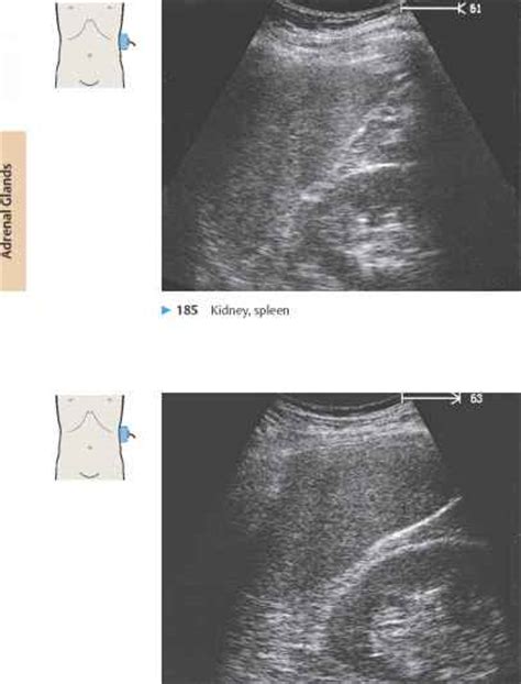 Adrenal Gland On Ultrasound