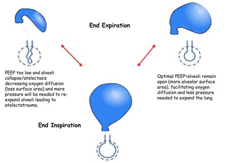 Optimal PEEP - REBEL EM - Emergency Medicine Blog