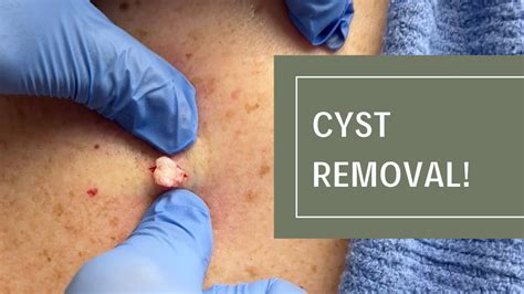 Cyst Removal! | Dr. Derm - YouTube