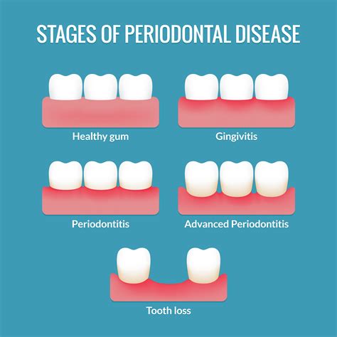 What is Gum Disease - Dr Bruno Silva Explains : Dental Implants