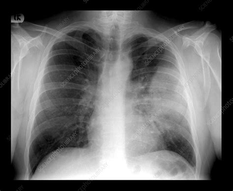 Lobar Pneumonia on Chest X-ray - Stock Image - M240/0753 - Science Photo Library