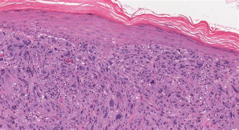 Atypical fibroxanthoma | Atlas of Pathology