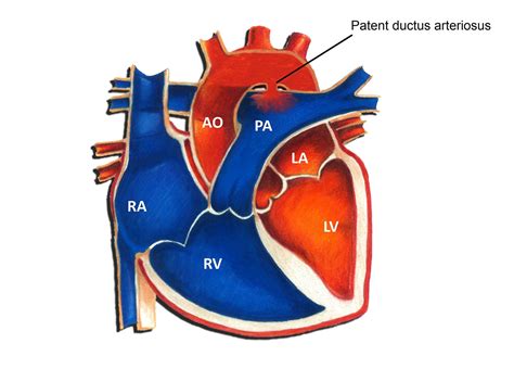 Patent Ductus Arteriosus (PDA) - How To Guide | Tips And Tricks ...