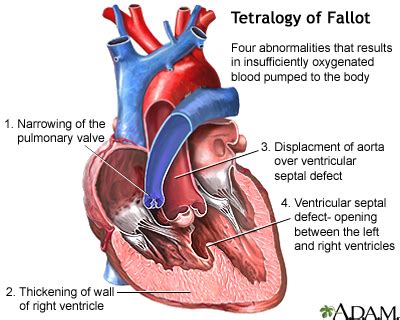 Tetralogy of Fallot: MedlinePlus Medical Encyclopedia Image