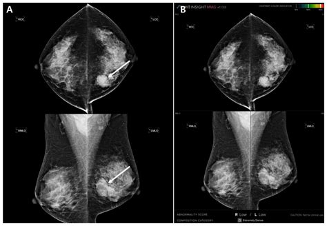 Diagnostics | Free Full-Text | Comparison of Diagnostic Performance in Mammography Assessment ...