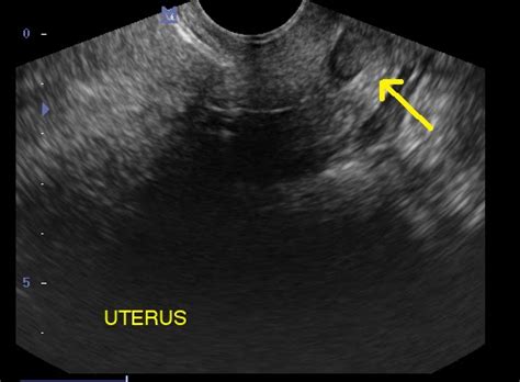 Endocervical Fibroid Polyp-USG - Sumer's Radiology Blog