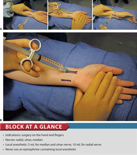 What Is A Nerve Block For Hand Surgery - Printable Templates Free
