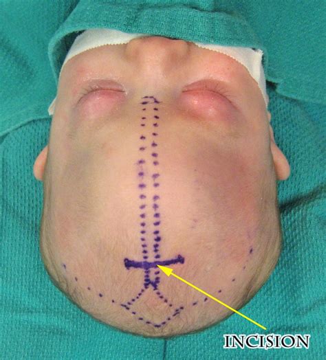 Metopic Synostosis Facts and Photos | Craniosynostosis