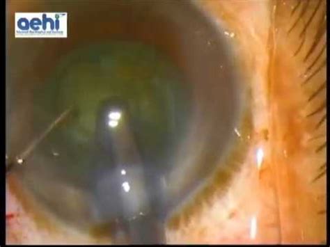 Combined Cataract and Glaucoma Surgery at Advanced Eye Hospital, Mumbai, India - YouTube