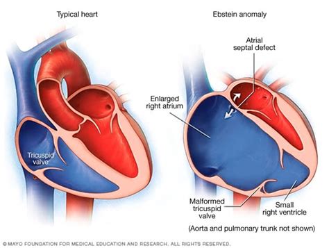 Tricuspid valve regurgitation - Symptoms and causes - Mayo Clinic