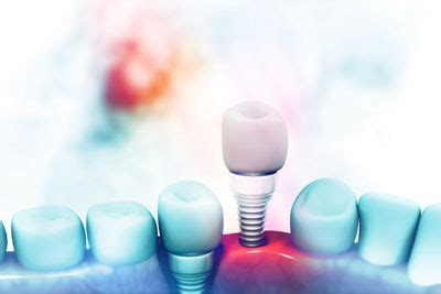 What You Should Know About The Dental Implant Procedure - Light Breeze ...