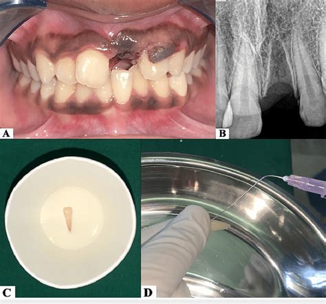 (A) Pre-operative clinical image. (B) Pre-operative radiograph showing... | Download Scientific ...