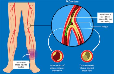 Peripheral Vascular Disease - Vista Vascular Clinic