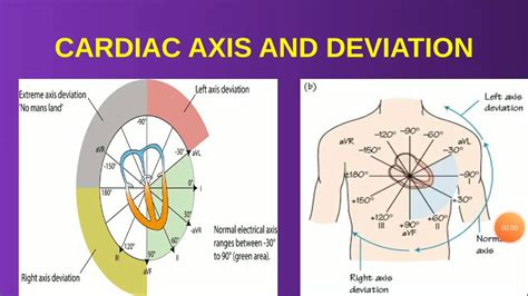 Cardiac Axis And Axis Deviation Explained With Ecg Findings Youtube – Theme Loader