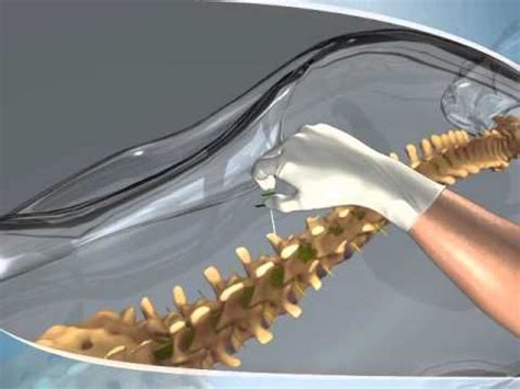 What to expect during a Myelogram procedure | Nursing procedures, Diagnostic imaging, Nursing ...