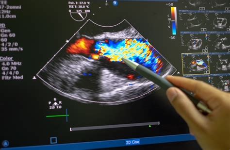 Diagnosing Aortic Stenosis | Dr. Raghu