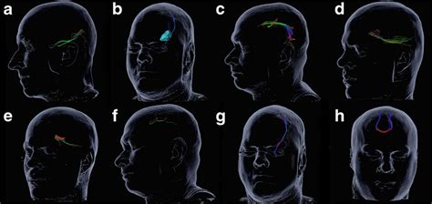 Subcortical fiber tracts. Figure 2 shows an example of the nine ...