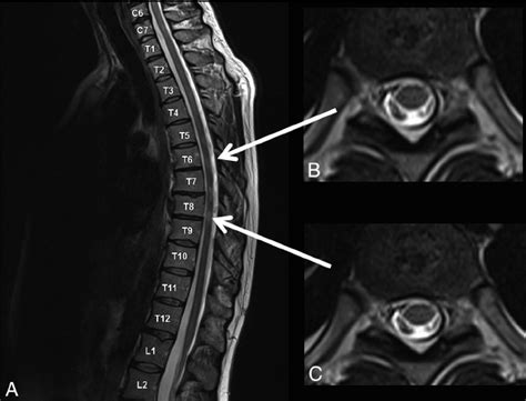 Examples of spinal cord lesions detected only on sagittal scans ( A ...