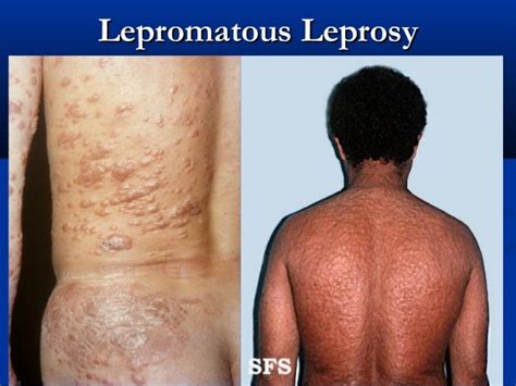 Leprosy