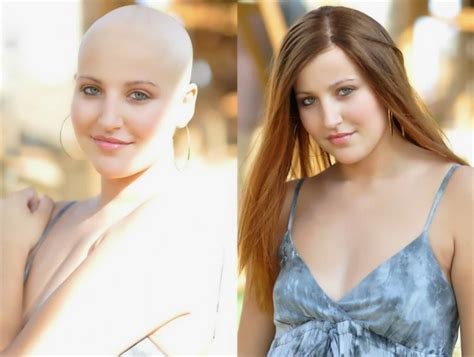 Hair Wigs for Cancer Patients : Overview on Cancer Patient Hair Wigs