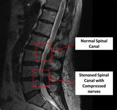 Spinal Stenosis Mri