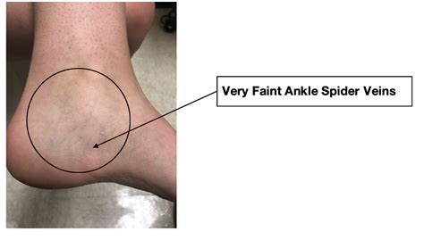 What to look for: Ankle and Spider Veins