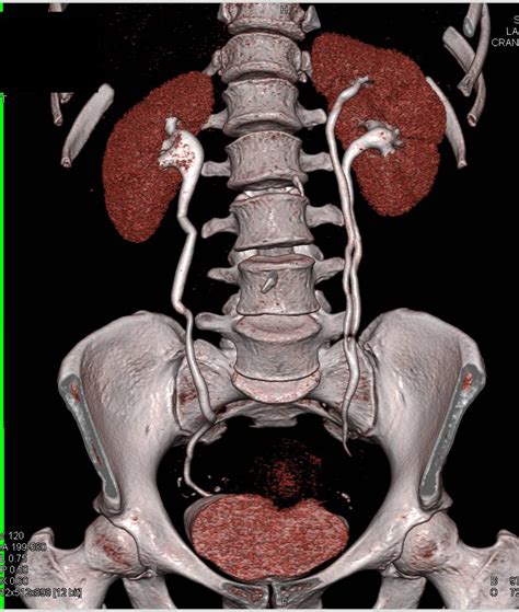 CT Urogram with Duplicated Collecting System on the Left - Kidney Case Studies - CTisus CT Scanning