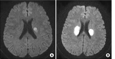 Figure 1 from Early Recurrent Right Basal Ganglia Infarction after Intravenous Thrombolysis for ...