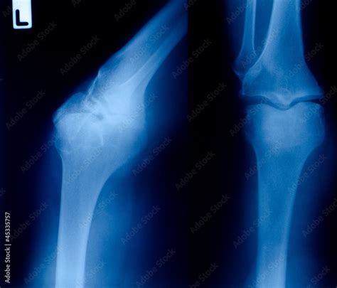 X ray film of knee fracture Stock Photo | Adobe Stock