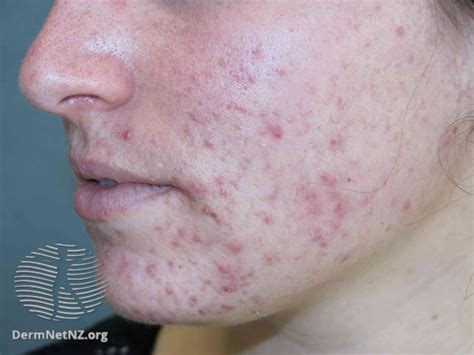 Acne: Treatment, Types, and More