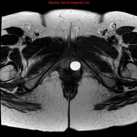 Bartholin gland cyst | Radiology Reference Article | Radiopaedia.org