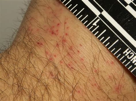 What Do Bed Bugs Bites Look Like? Pictures of Bed Bug Bites - PestGuide.org