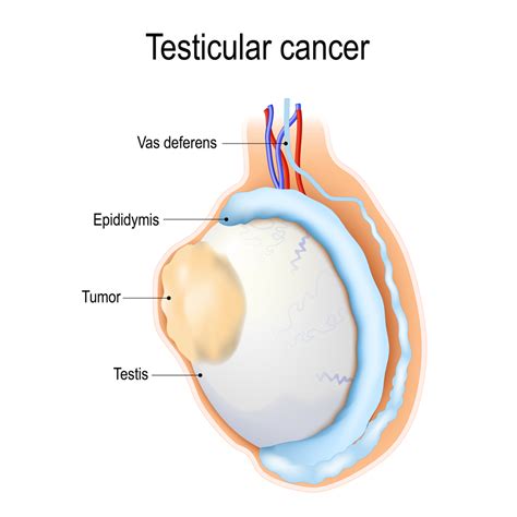 Testicular Cancer: Symptoms, Stages, Diagnosis, Risk Factors & Treatment