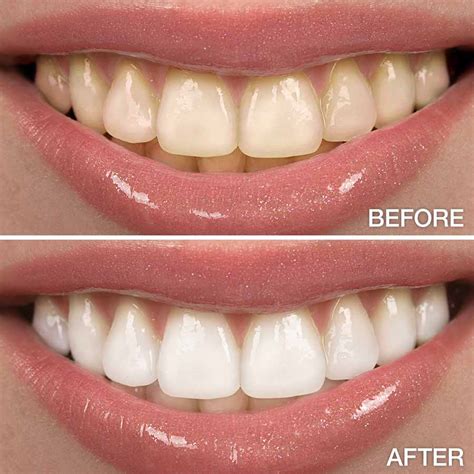 Teeth Whitening | Cosmetic Dentistry | Walnut Creek