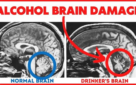 11 Ways Alcohol Induces Brain Damage Archives - Alcohol Mastery